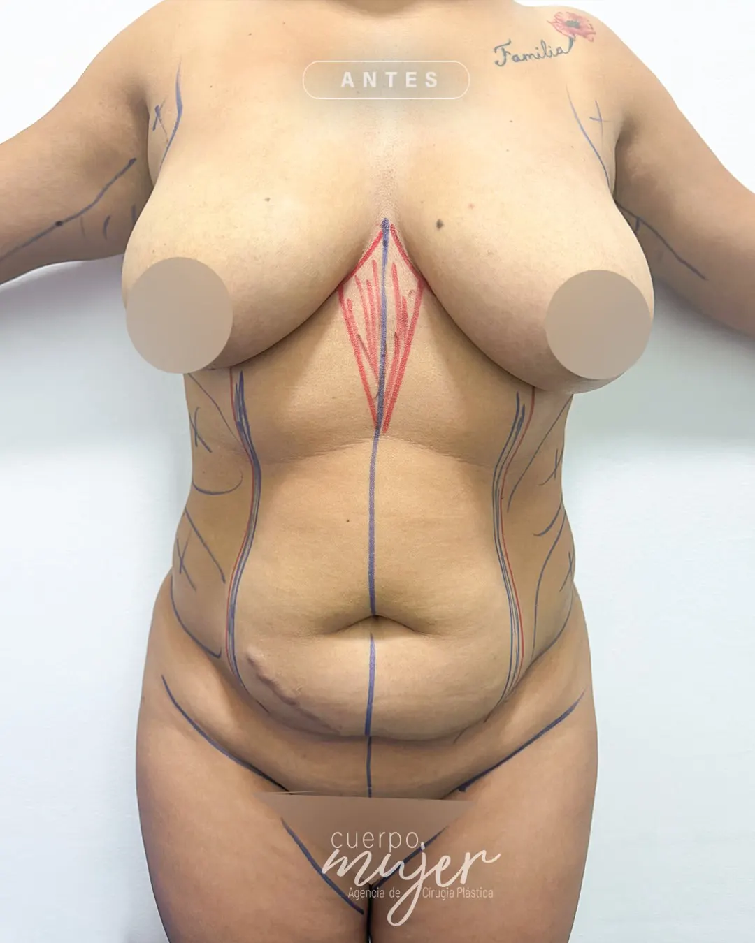 Abdominoplastia caso (1)