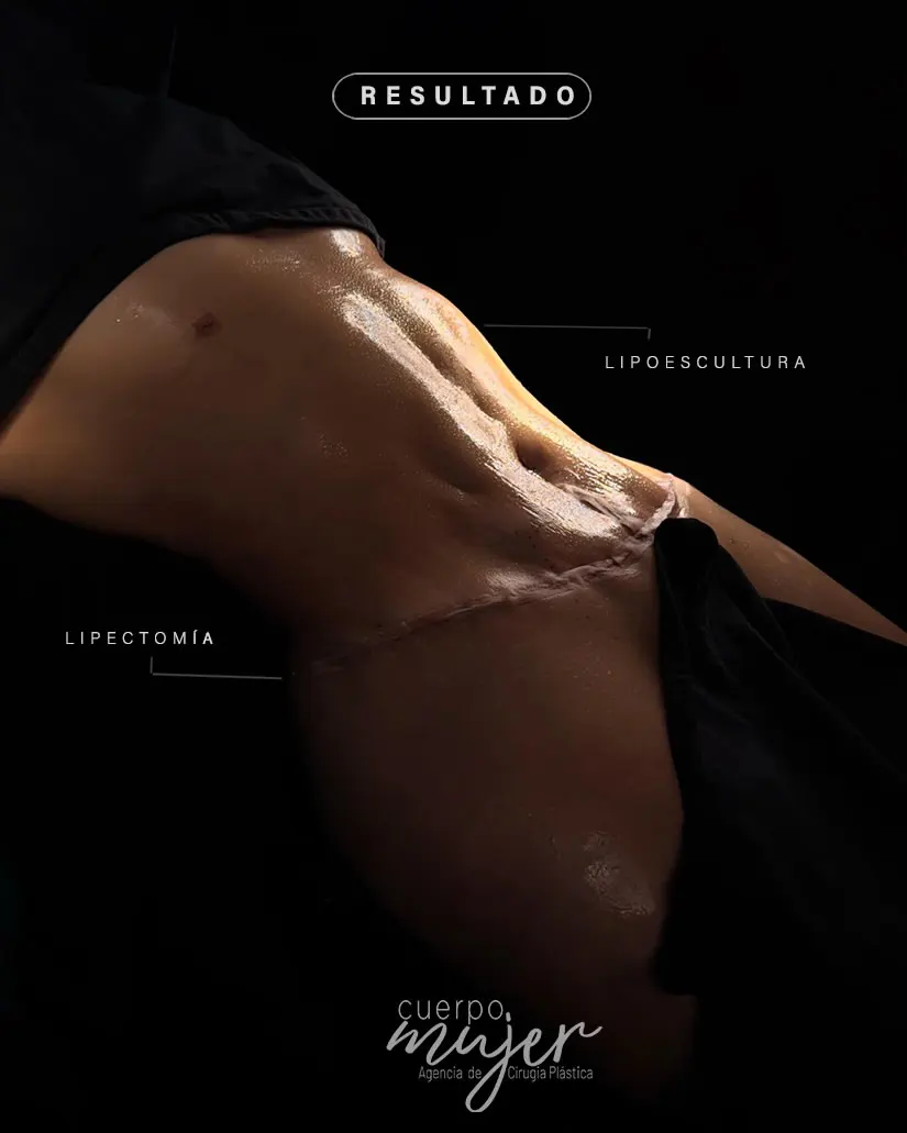 Abdominoplastia caso 2 (1)