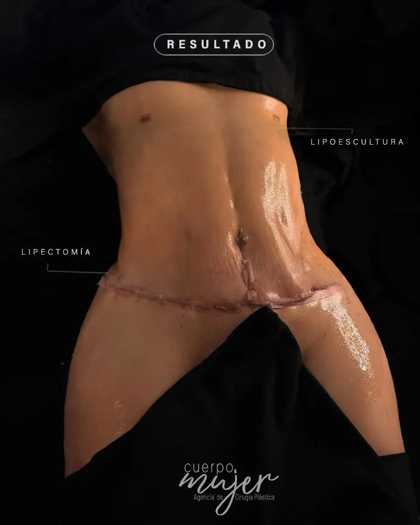 Resultado Abdominoplastia Perfil Caso 2
