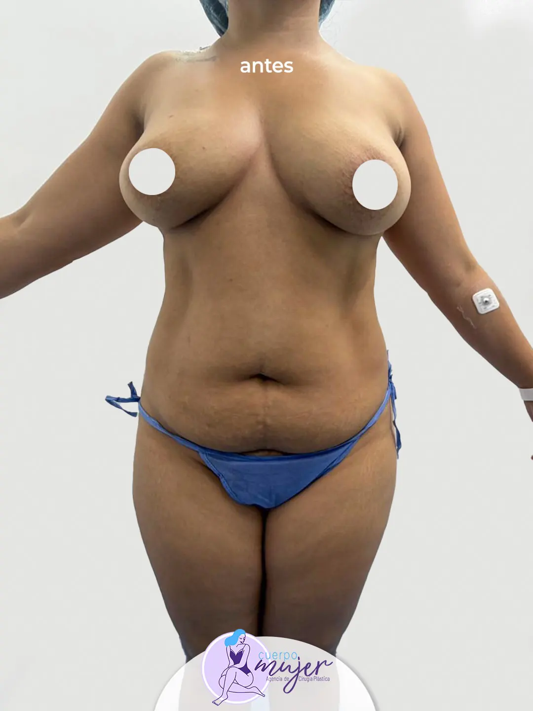 Antes Abdominoplastia Caso 3