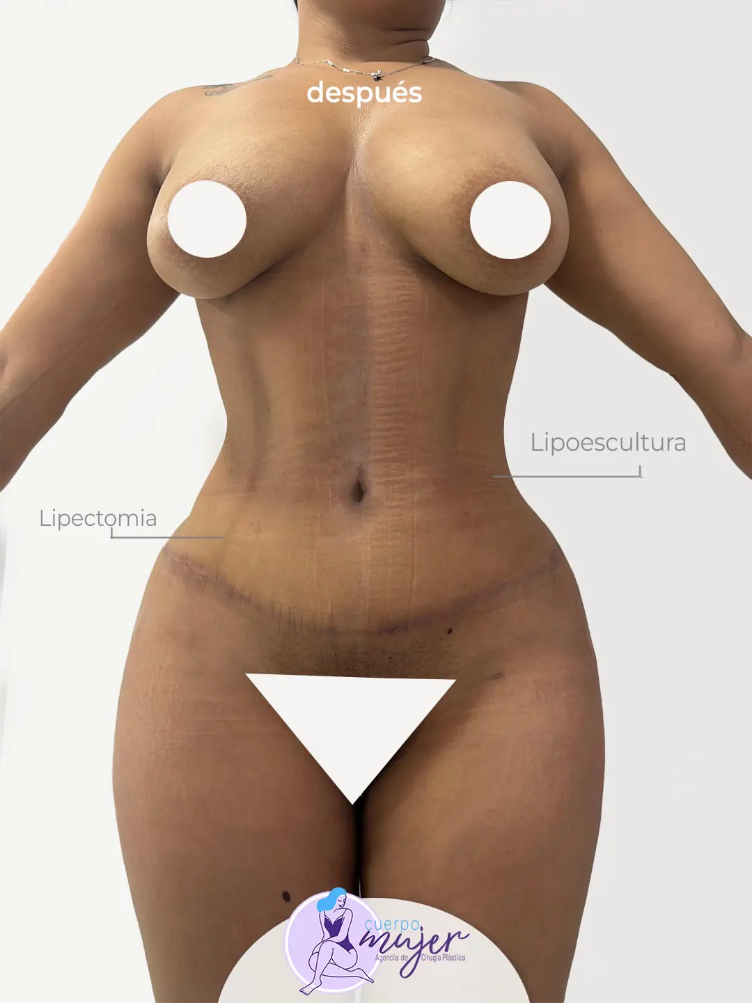 Después Abdominoplastia Caso 3