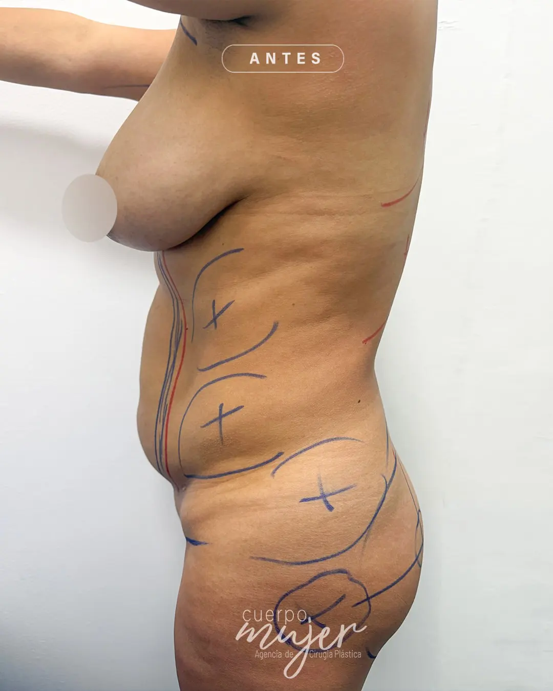 Antes Abdominoplastia Perfil Caso 1