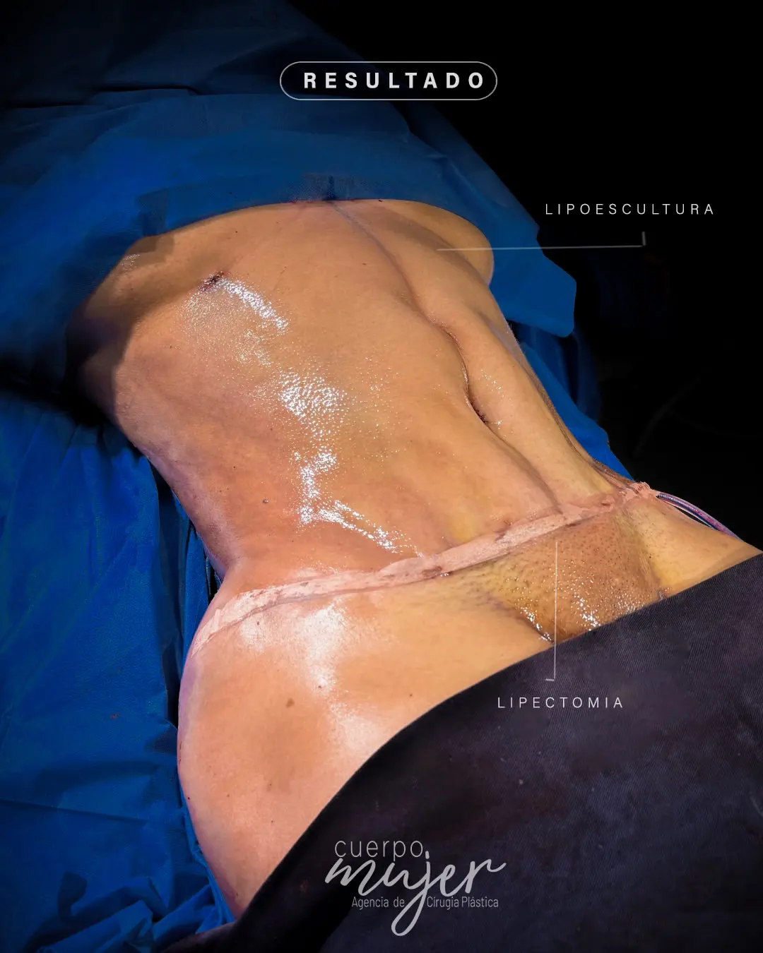 Resultado Abdominoplastia Perfil Caso 1