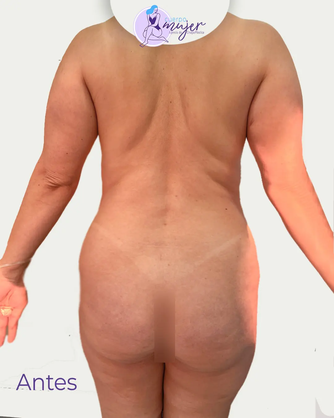 Antes Abdominoplastia Perfil Caso 4