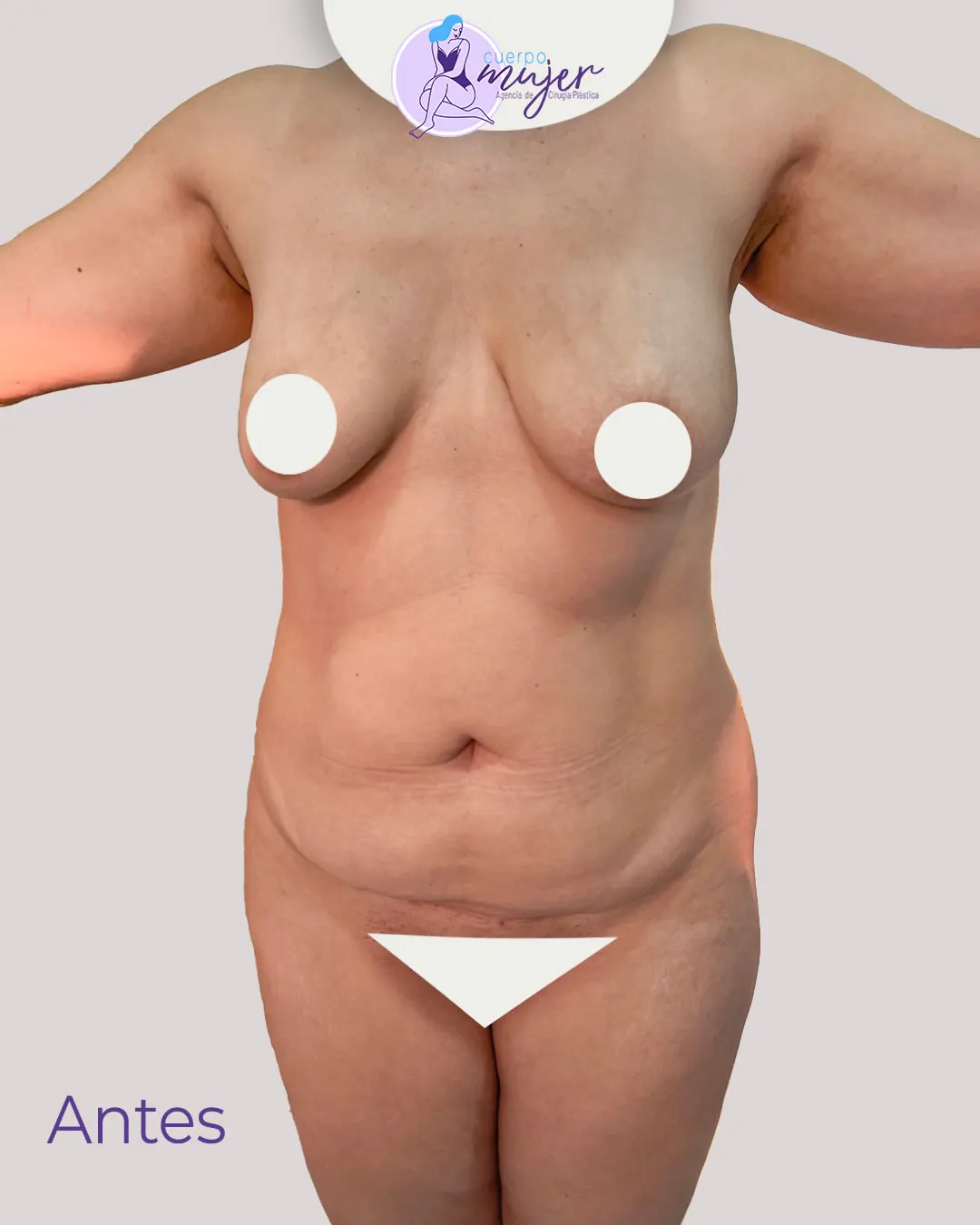 Antes Abdominoplastia Caso 4