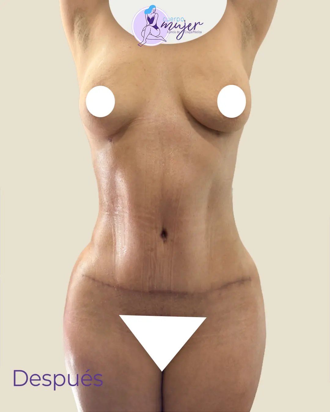 Después Abdominoplastia Caso 4