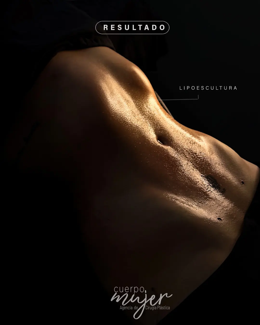 Resultado Lipoescultura Cuerpo Mujer 1