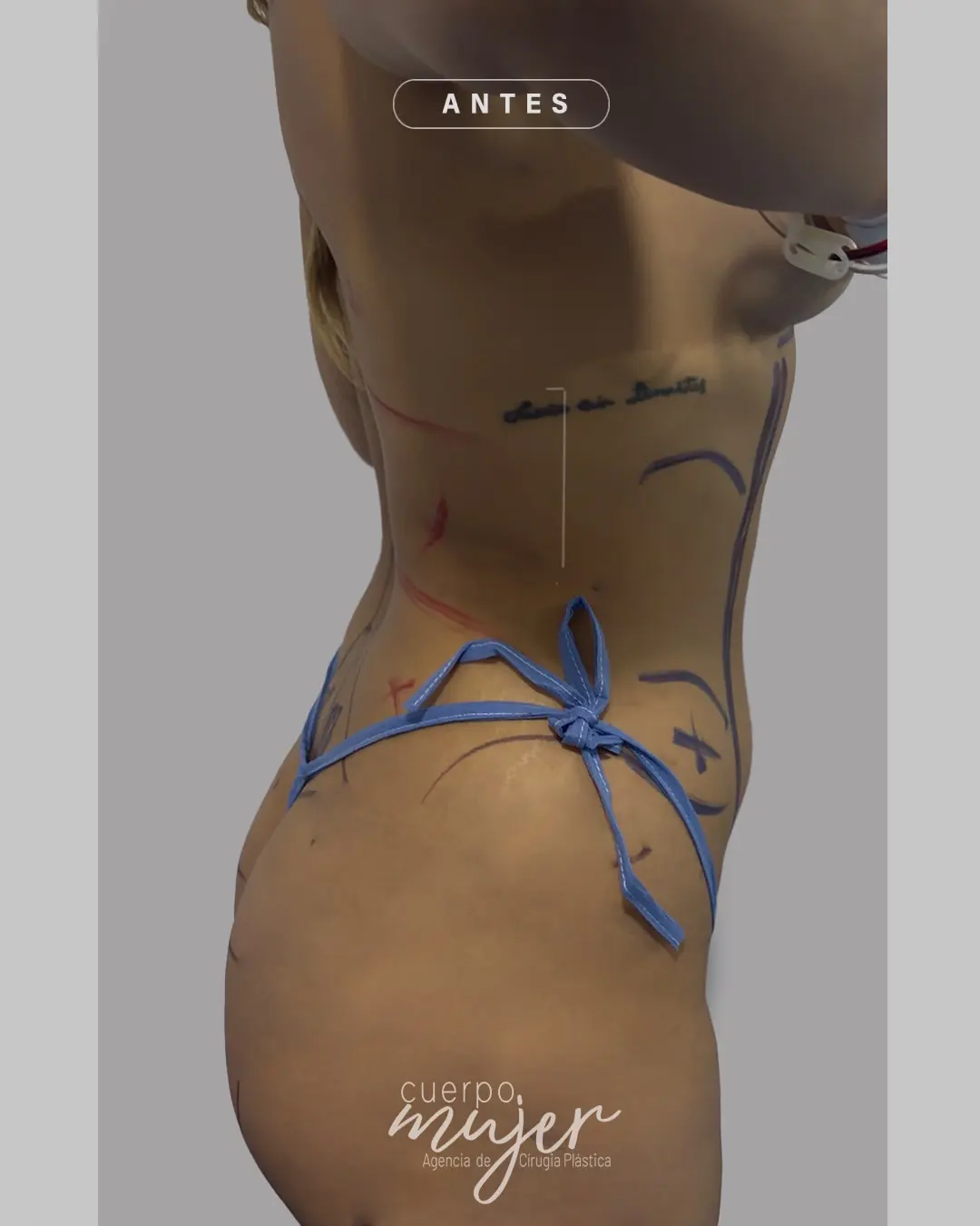 Lipoescultura (5)