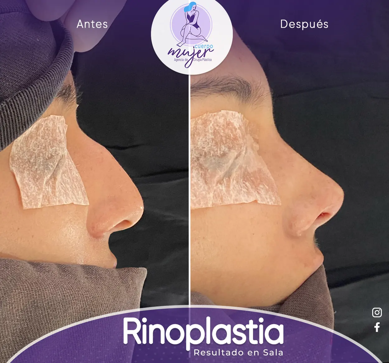 Rinoplastia Caso 1