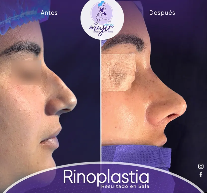 Rinoplastia Caso 11