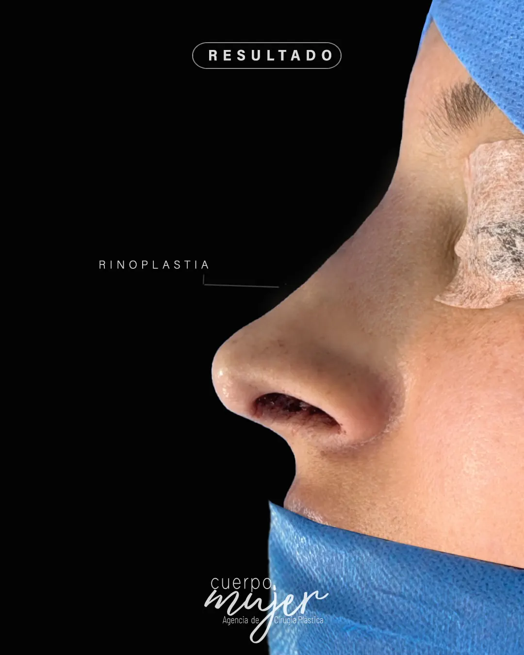Rinoplastia Antes Caso 12