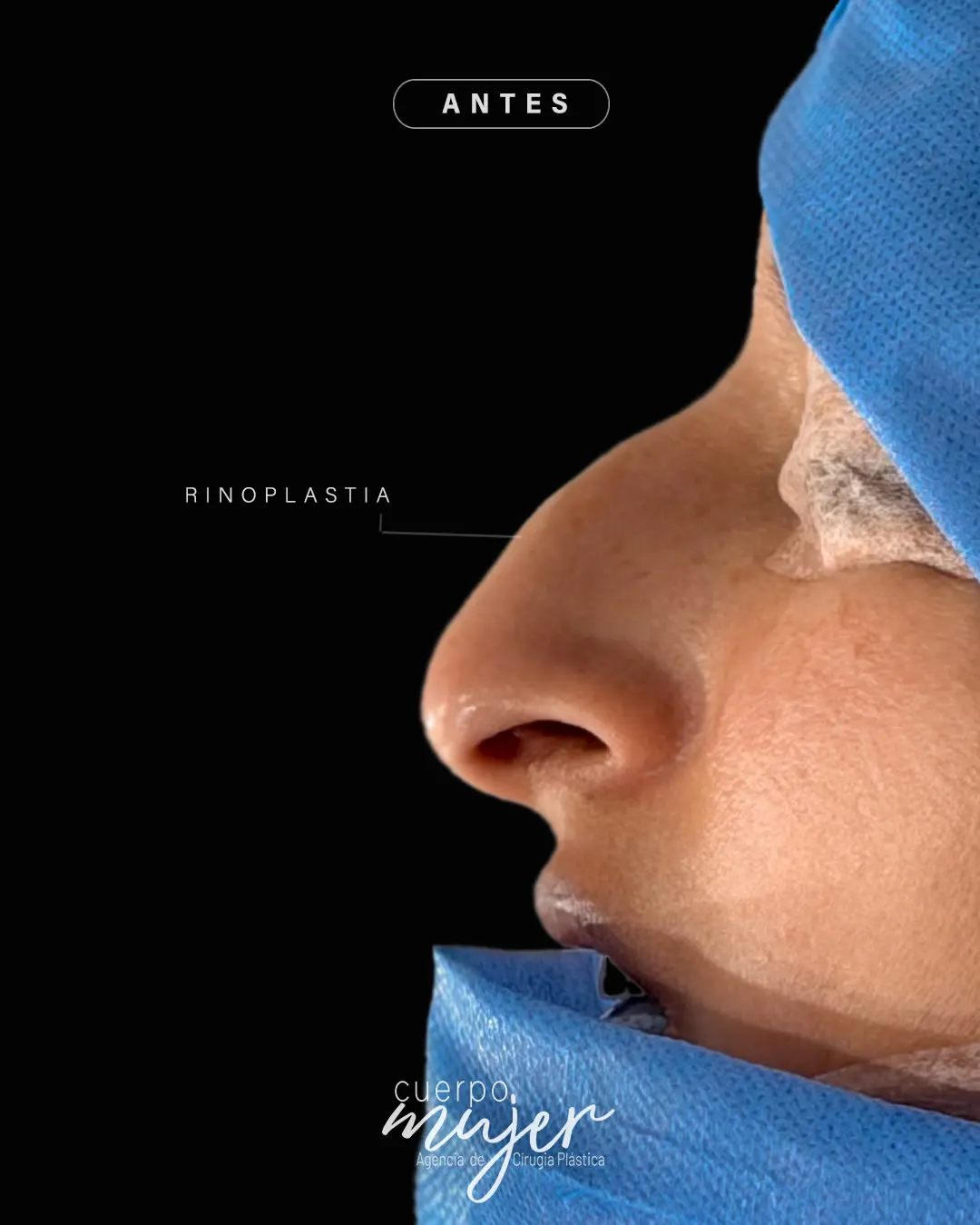 Rinoplastia Después Caso 12