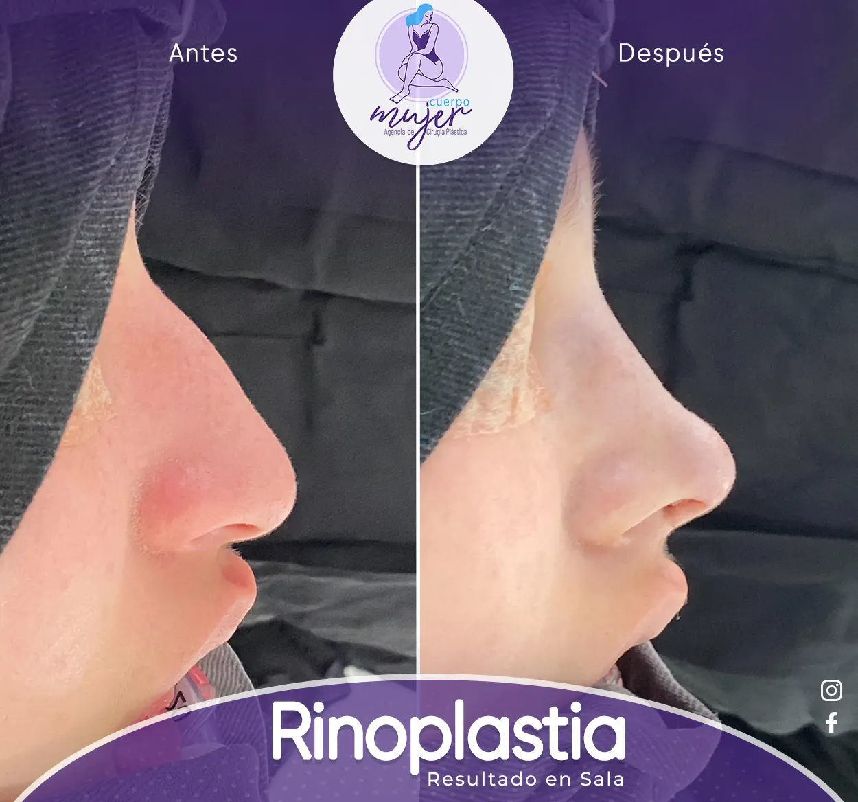Rinoplastia Caso 2