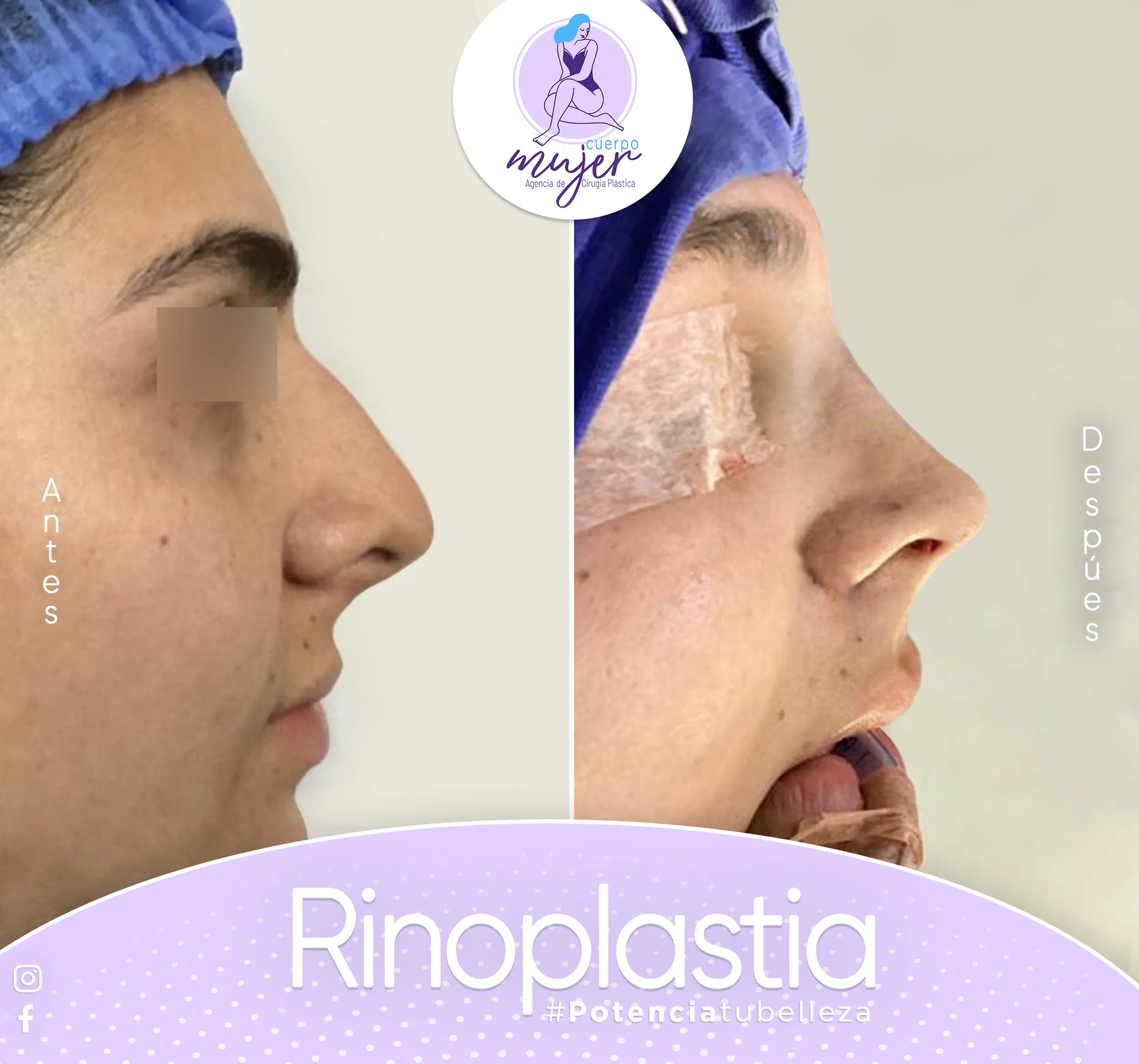 Rinoplastia Caso 3