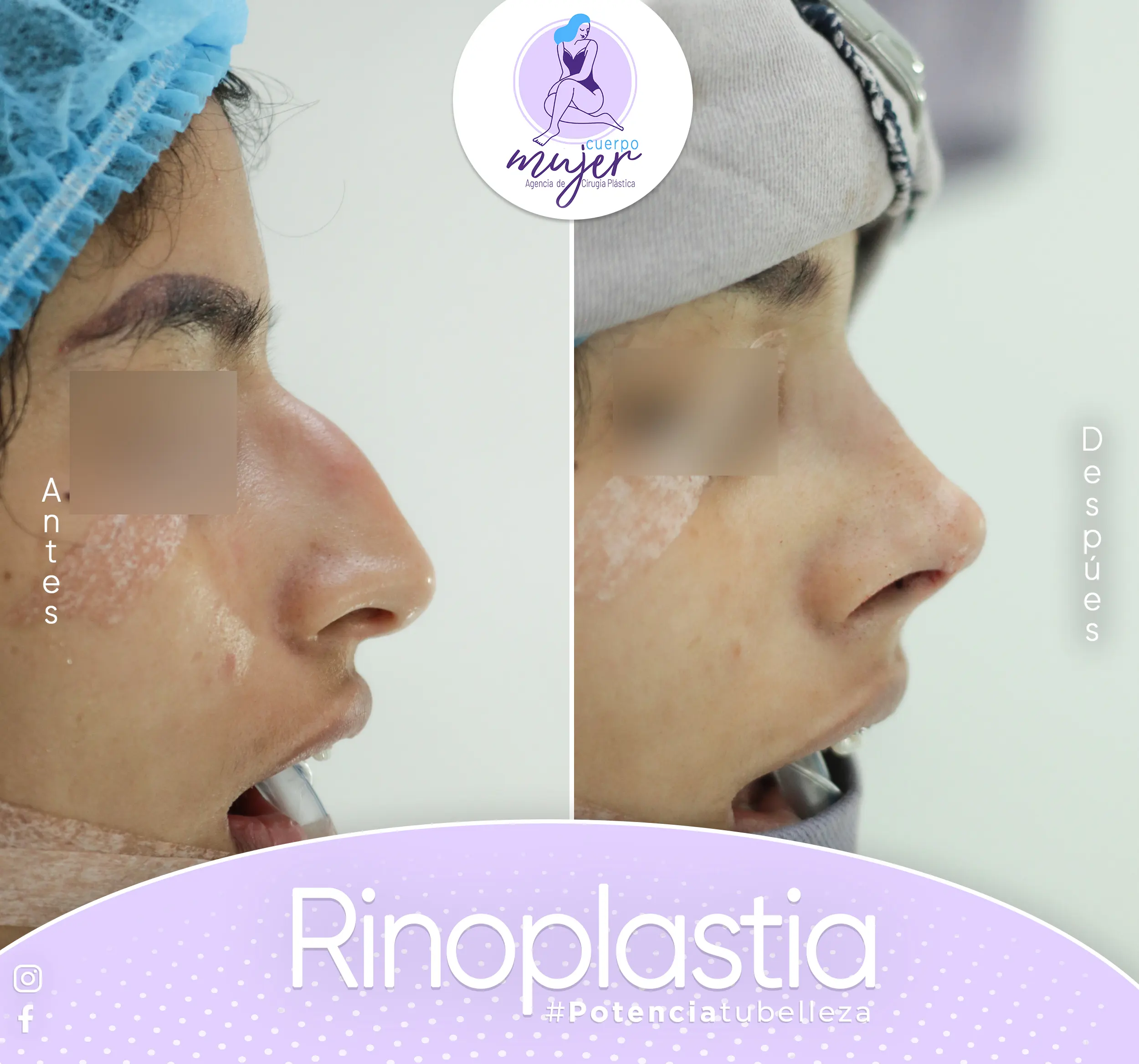 Rinoplastia Caso 4