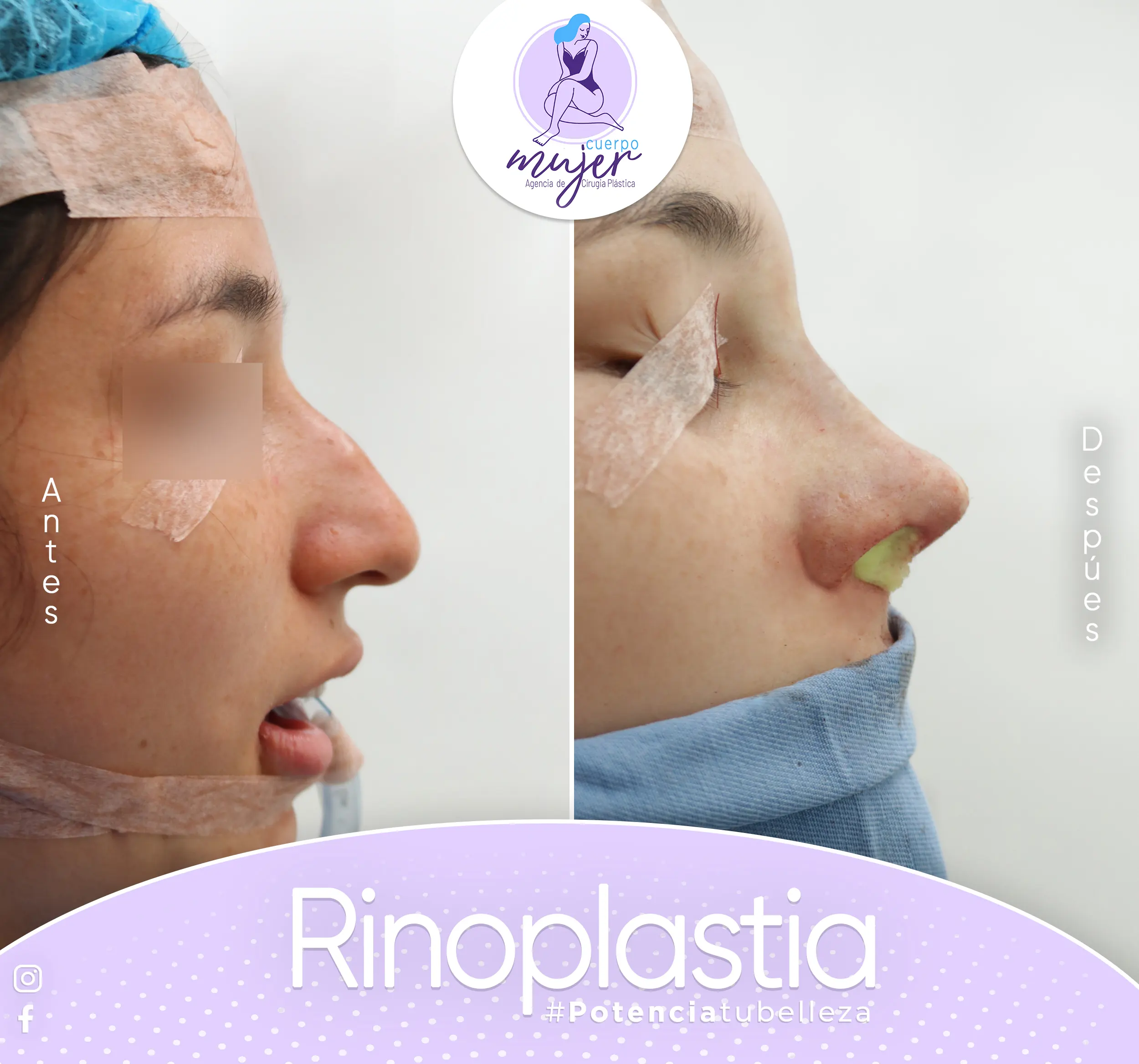 Rinoplastia Caso 5
