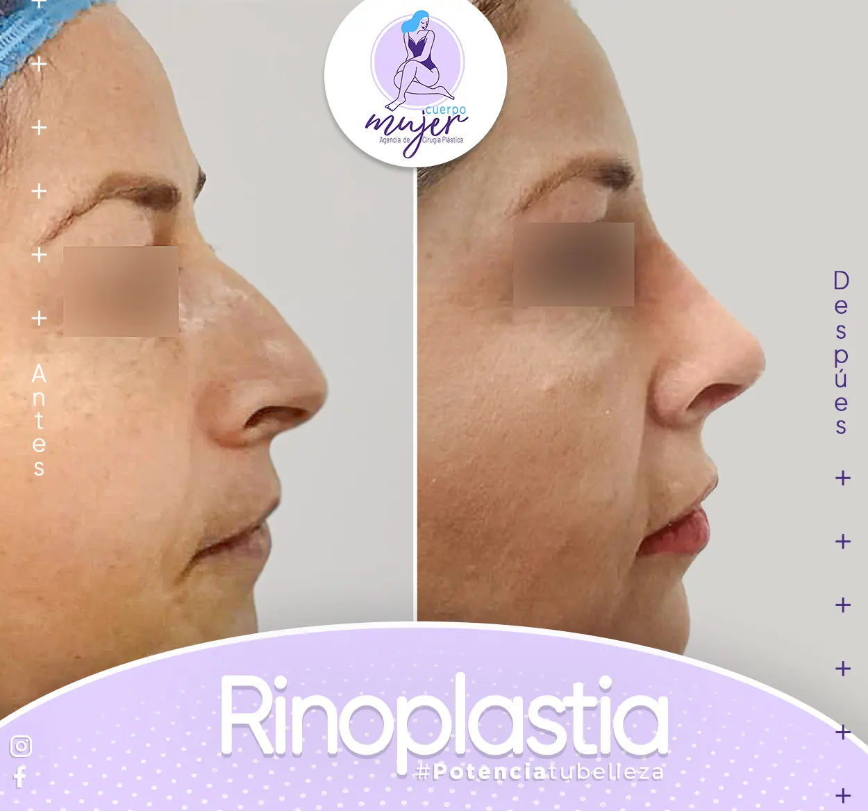 Rinoplastia Caso 6
