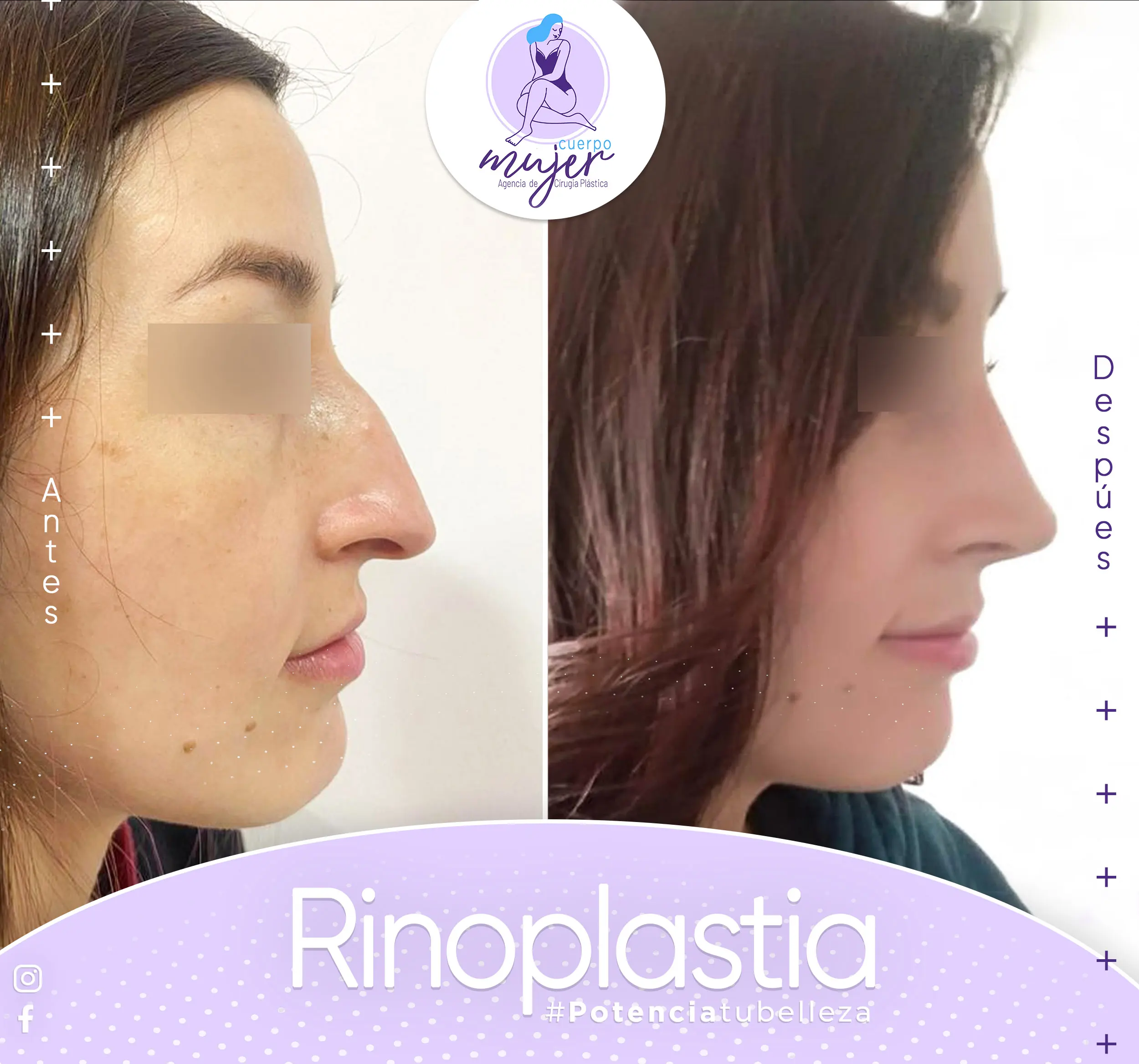 Rinoplastia Caso 7