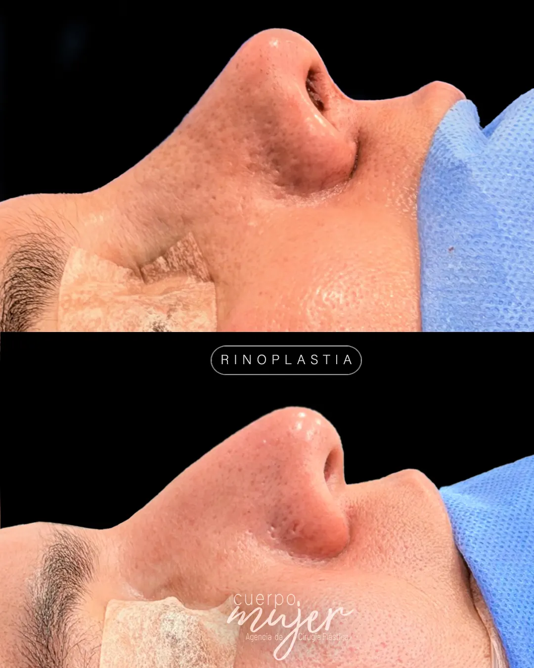 Rinoplastia Caso 8
