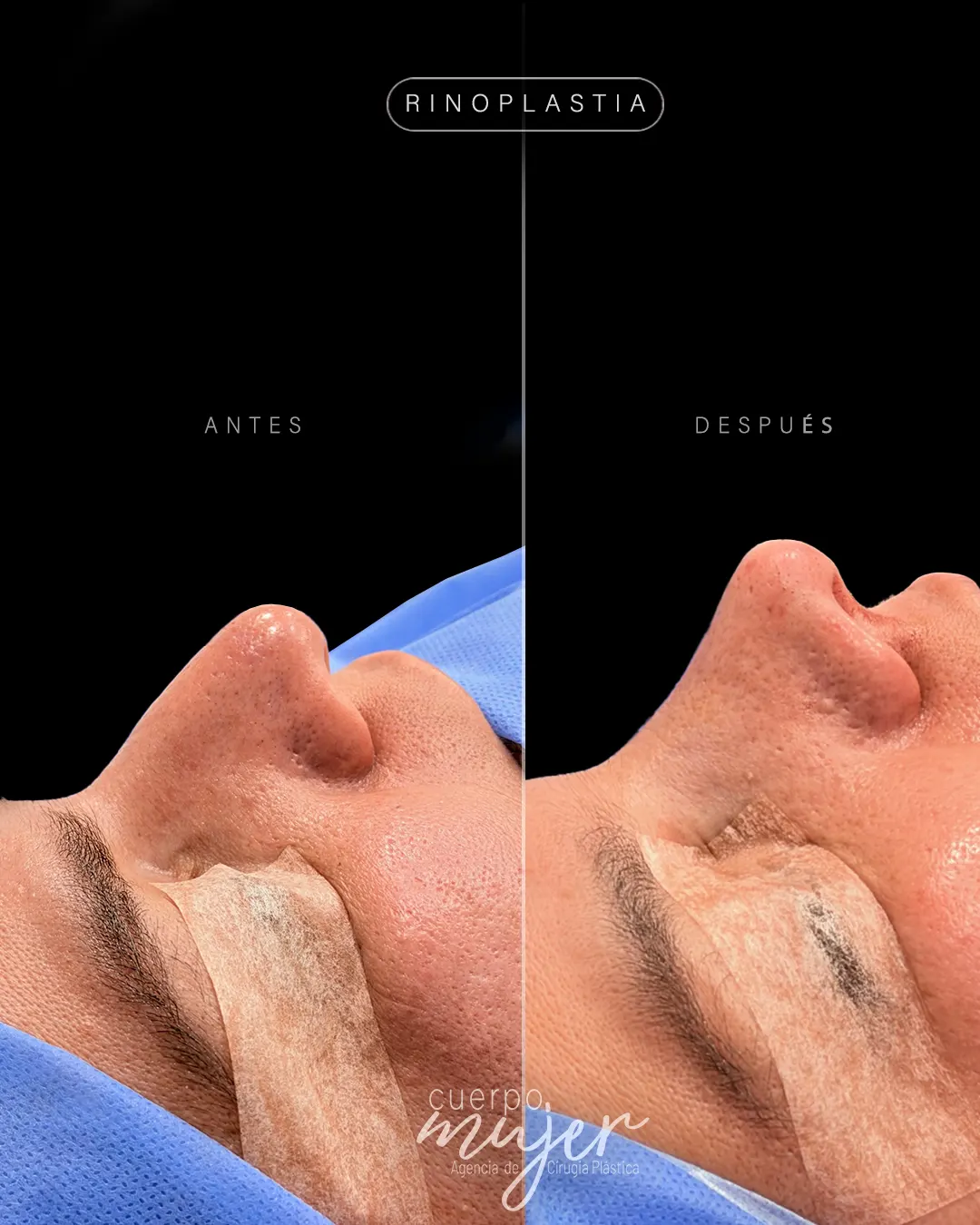 Rinoplastia Caso 9