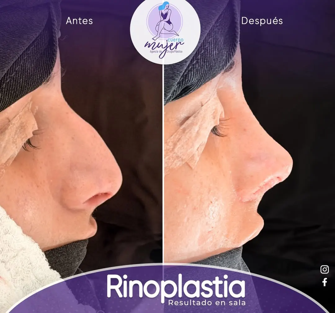 Rinoplastia Caso 13