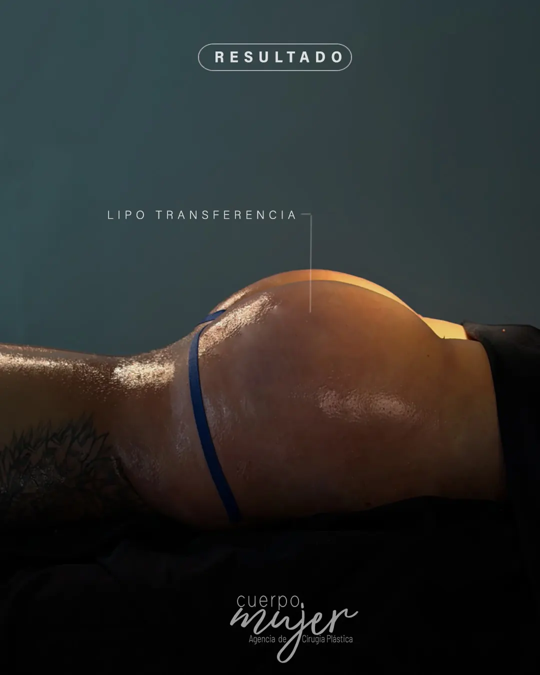Transferencia Glútea Caso 2 (1)