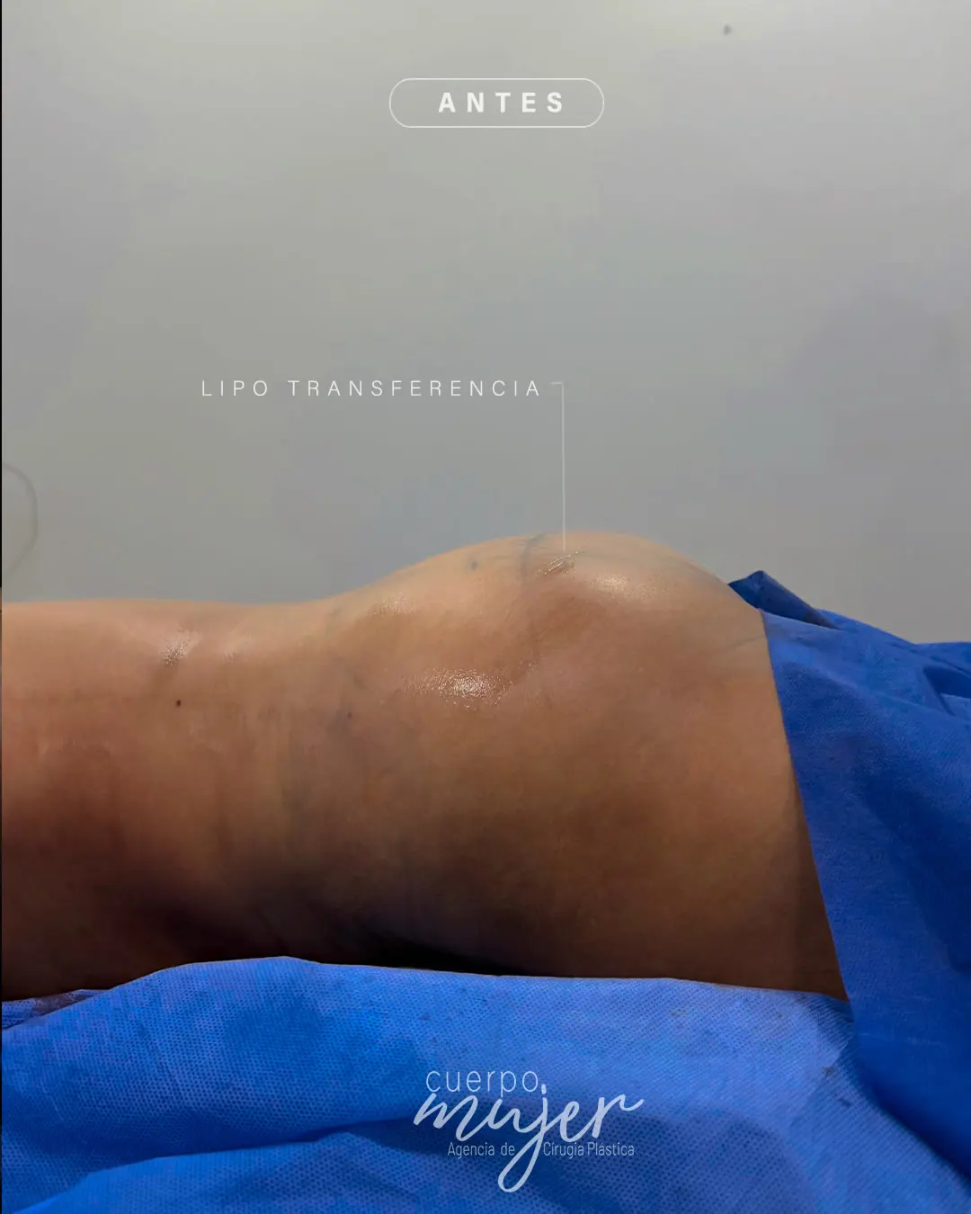 Transferencia Glútea caso 1 (1)