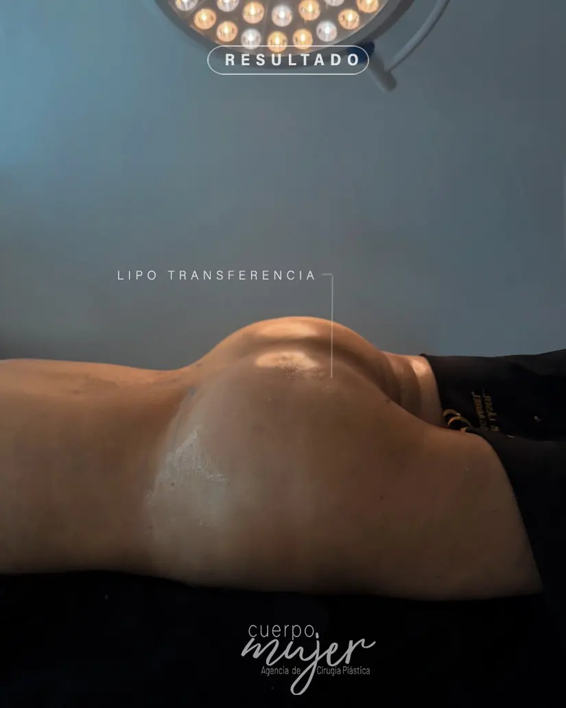 Transferencia Glútea caso 3 (2)