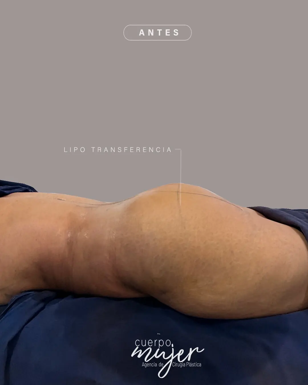 Resultado Transferencia Glútea 11