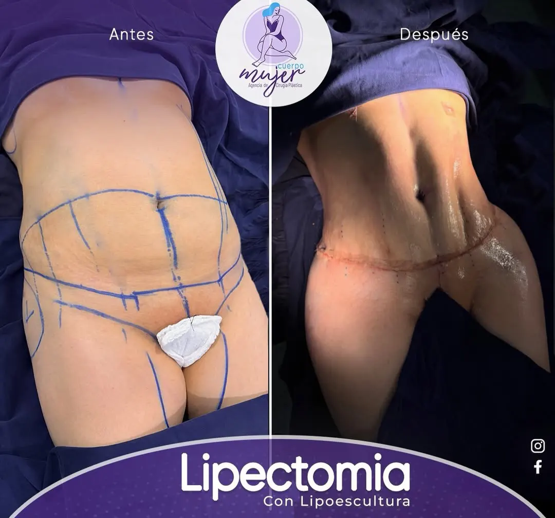 Composición Antes y Después Abdominoplastia 2