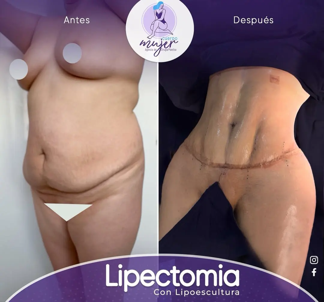 Composición Antes y Después Abdominoplastia 1