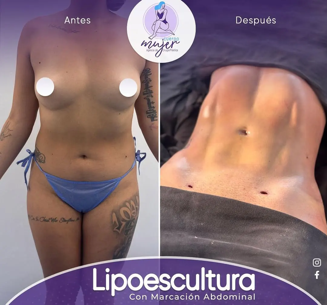Antes y Después Compuesto Lipoescultura Cuerpo Mujer
