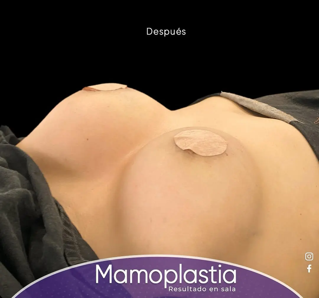 Después Mamoplastia de Aumento 2