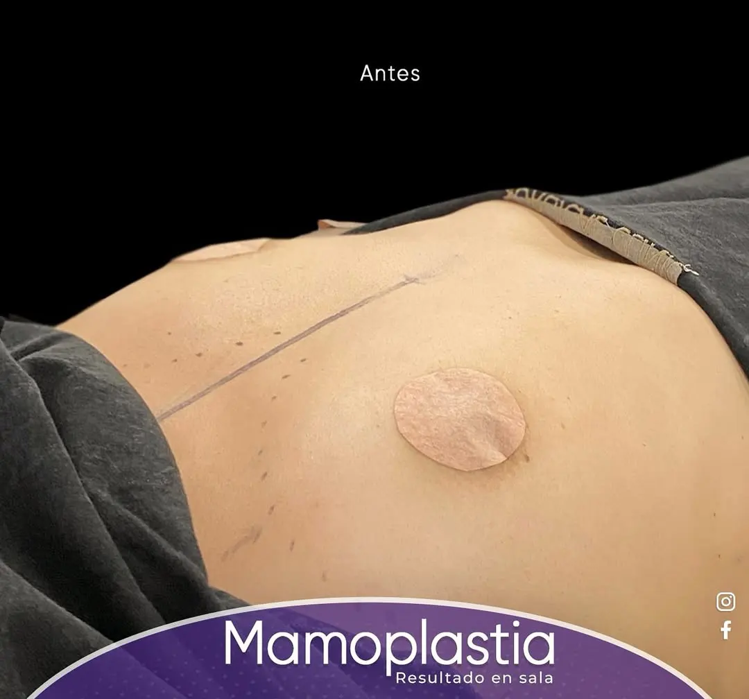 Antes Mamoplastia de Aumento 1