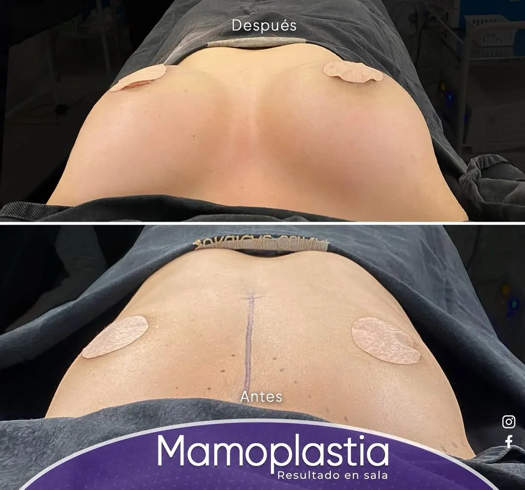 mamoplastia de aumento (3)
