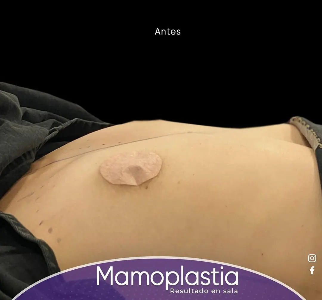 Antes Mamoplastia de Aumento 2