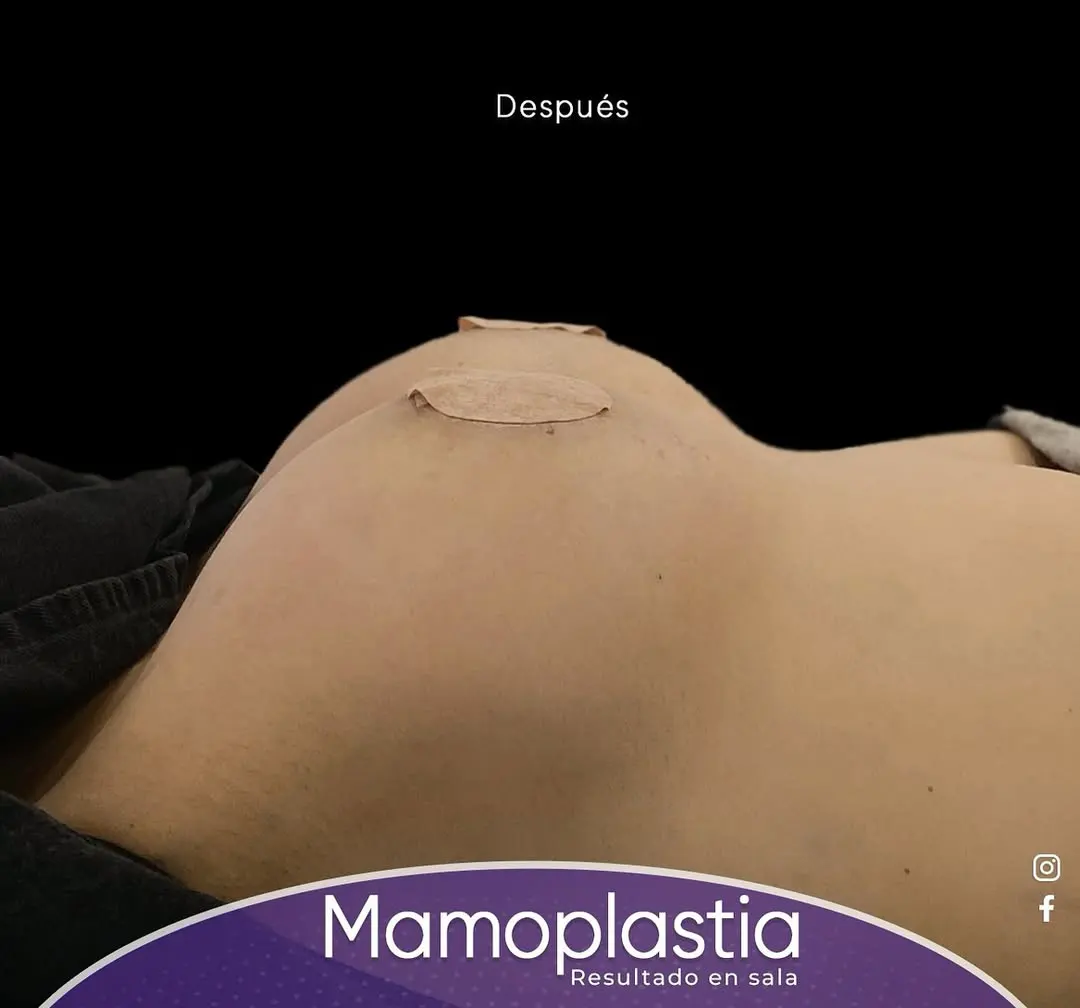 Después Mamoplastia de Aumento 1