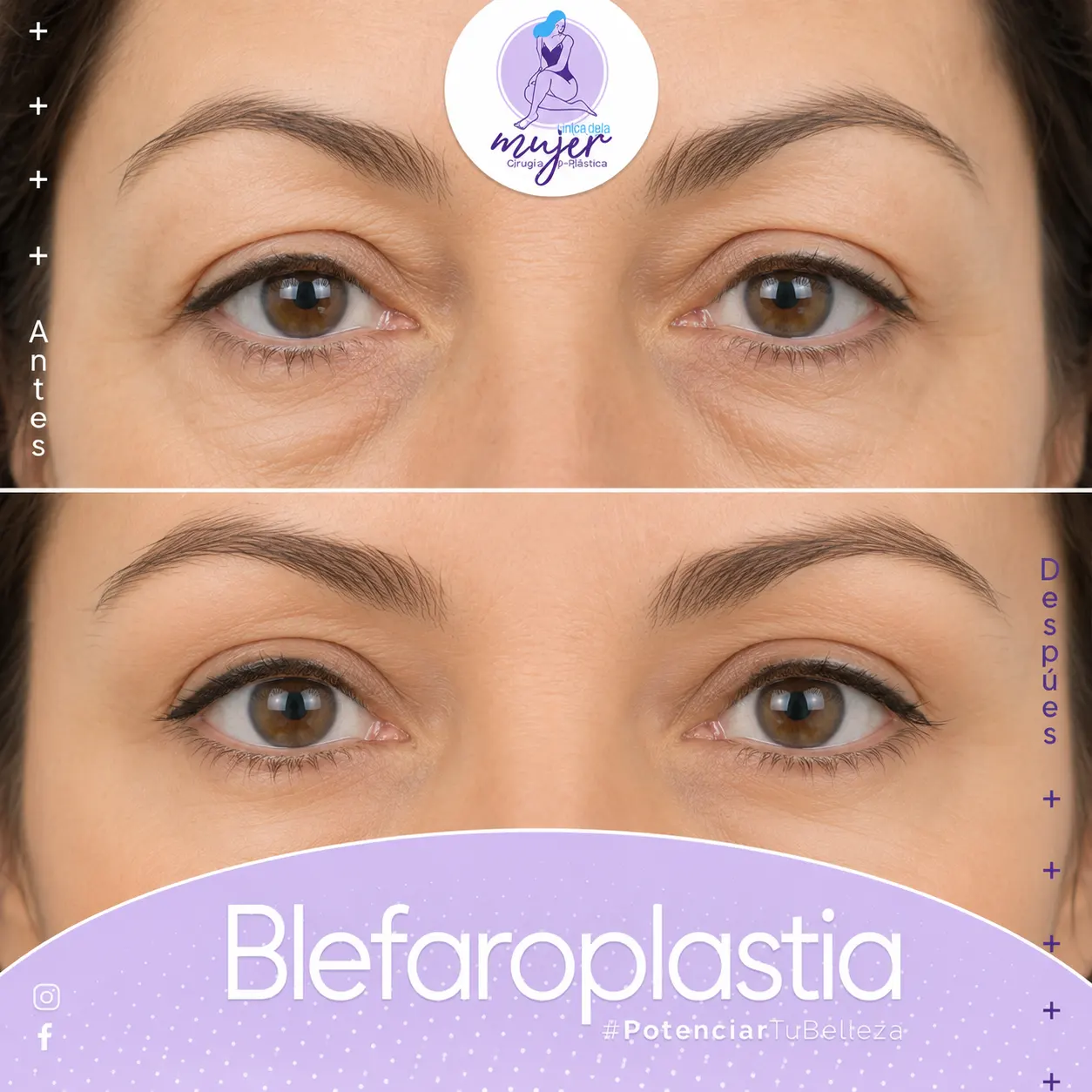 Blefaroplastia Caso 1