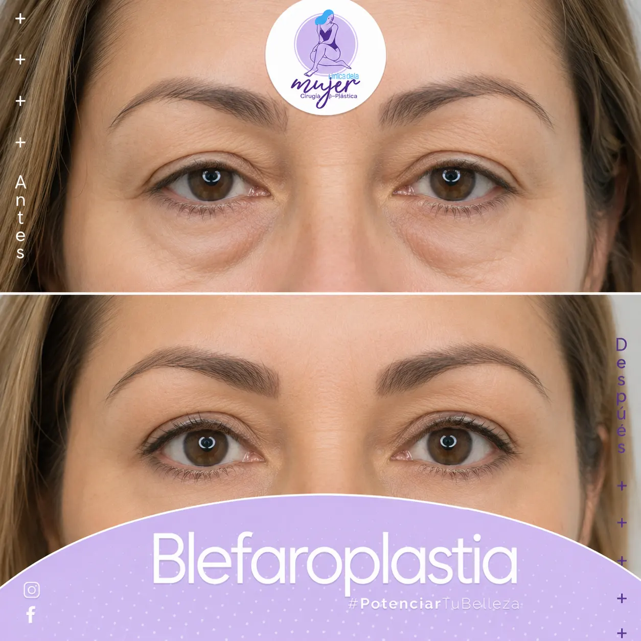 Blefaroplastia Caso 3