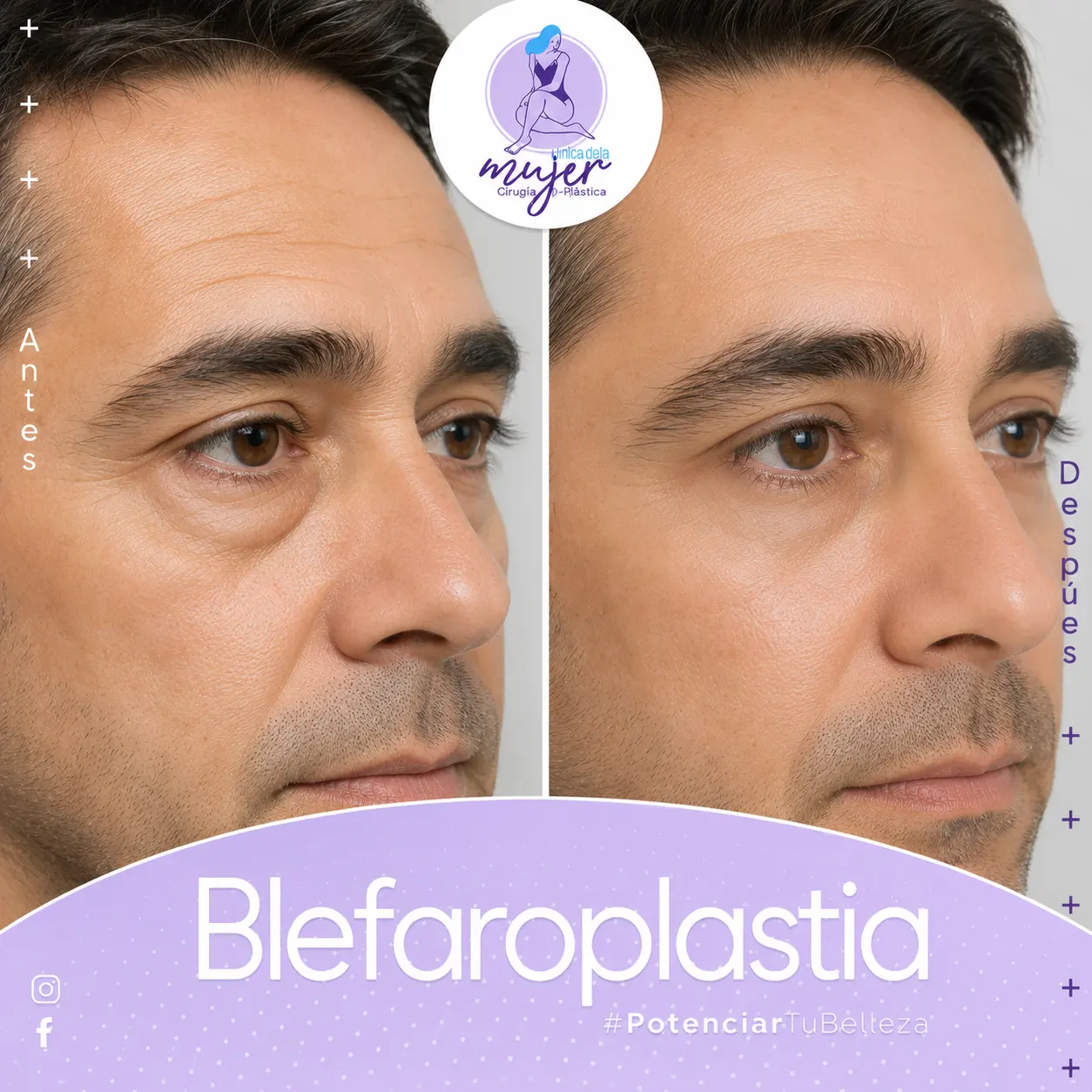Blefaroplastia Caso 2