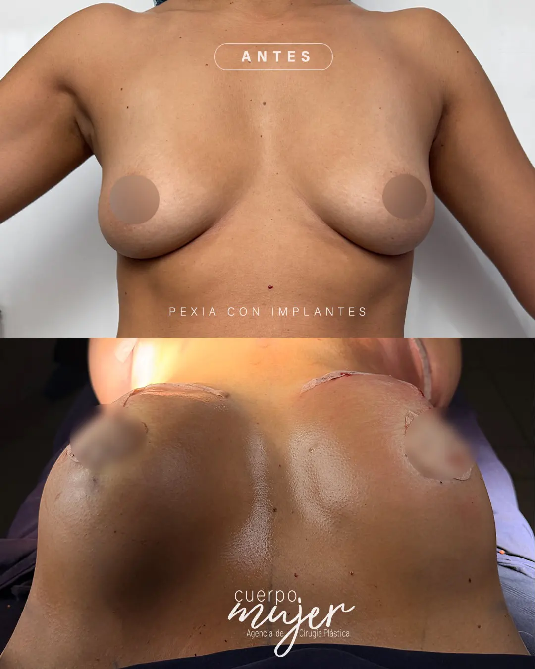 abdominoplastia con pexia antes y después - Cuerpo Mujer Agencia de Cirugía Plástica(2)